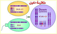 متلازمة داون