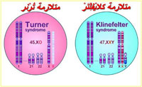 متلازمة كلاين وداون